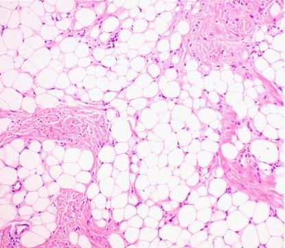 White adipose tissue, H&E (lipoma section). Mature unilocular adipocytes with the classic signet-ring appearance: large empty spaces after lipid extraction, thin cytoplasm rims, and peripheral haematoxylin-stained nuclei. Fibrous capsule and septal stroma visible.